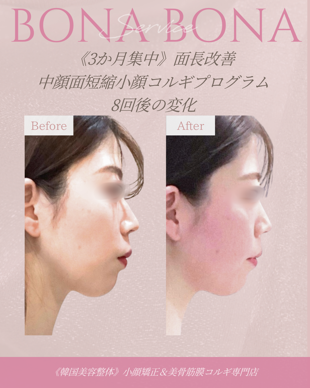 面長改善 中顔面短縮小顔コルギ 8回後の変化