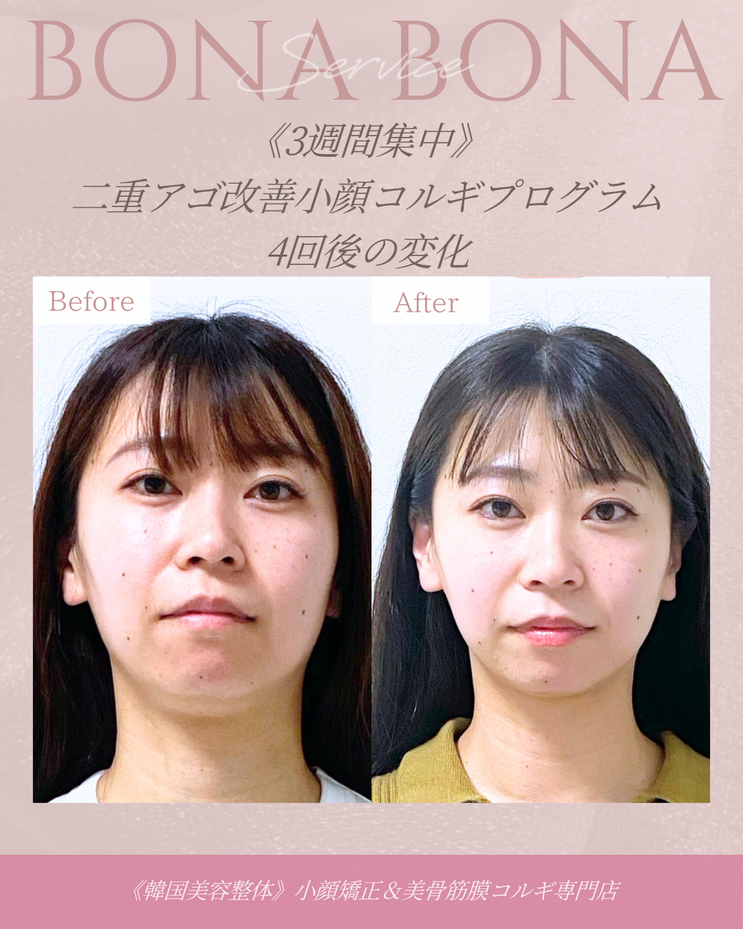 二重アゴ改善小顔コルギ 4回後の変化