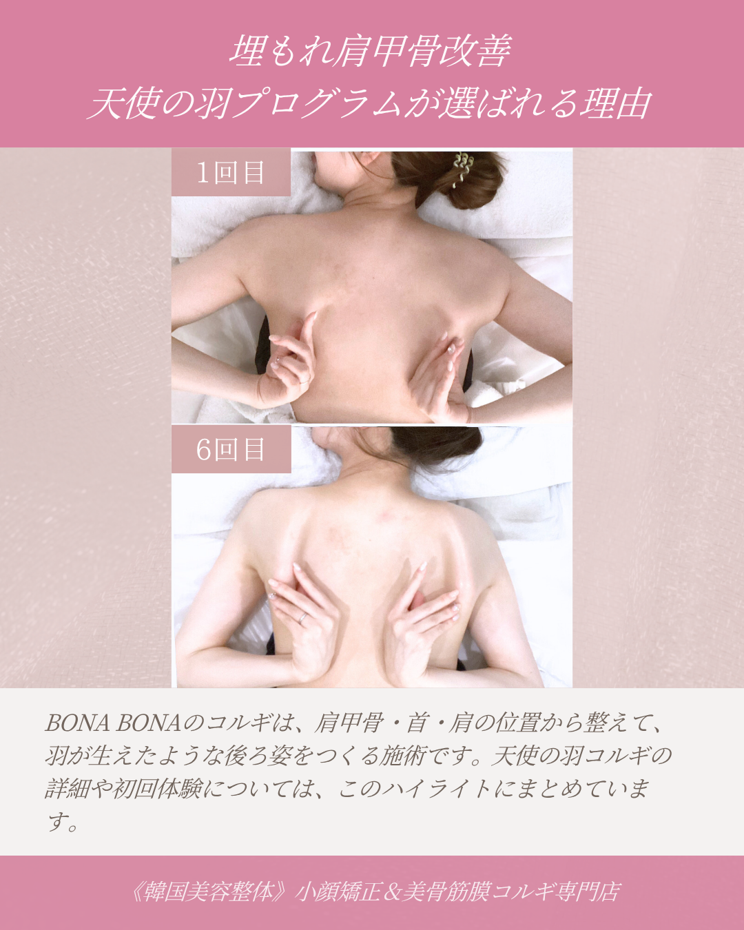 埋もれ肩甲骨改善 天使の羽プログラムが選ばれる理由
